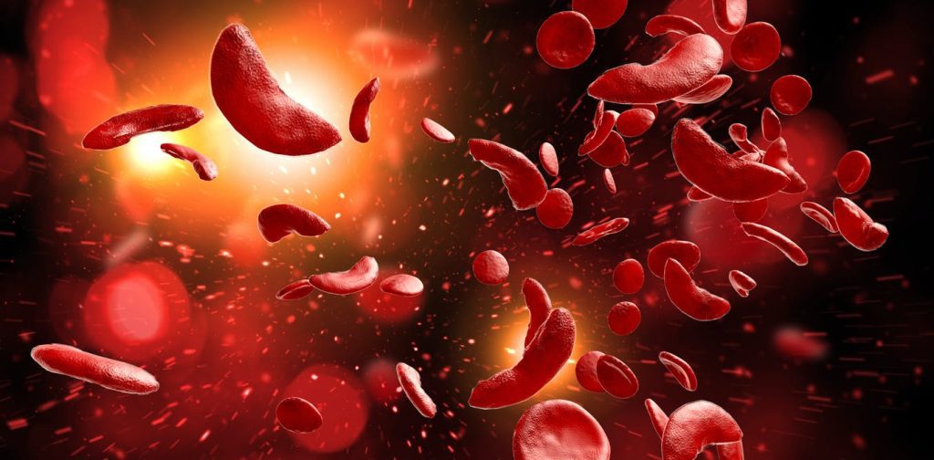 There's no cure for sickle cell disease, but spotting it early can improve treatment