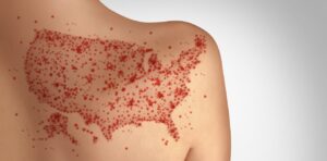 Measles can ravage the immune system and brain, causing long-term damage – a virologist explains